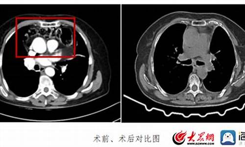 心包结核治疗中胸痛正常吗吃什么药好_结核性心包炎治疗