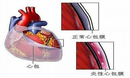 心包结核会不会传染_心包结核的症状是什么引起的怎么治疗