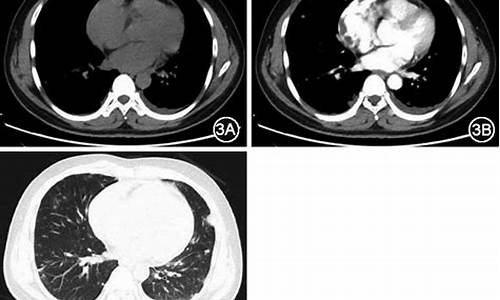 心包结核危害大不大怎么判断出来的_心包结核危害大不大怎么判断出来