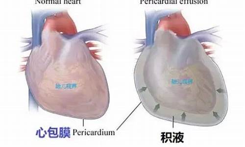 心包积液引起的结核的症状是什么_心包结核有没有积液没消的怎么