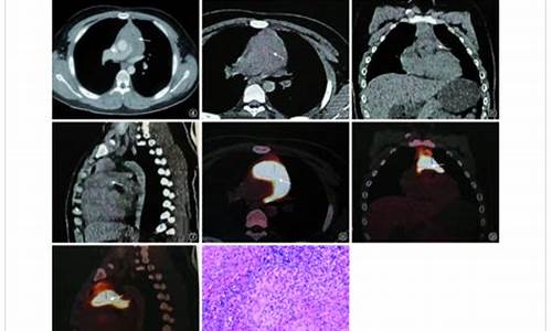 心包结核病例分析怎么做图片_心包结核病例分析怎么做